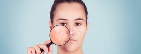 Noia sostenint una lupa davant de la galta a través de la qual es veu l'efecte de l'acne