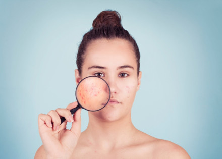 Noia sostenint una lupa davant de la galta a través de la qual es veu l'efecte de l'acne